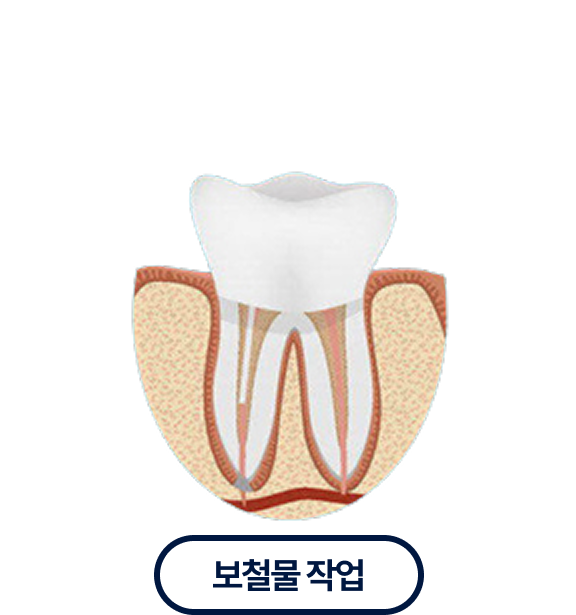 보철물작업
