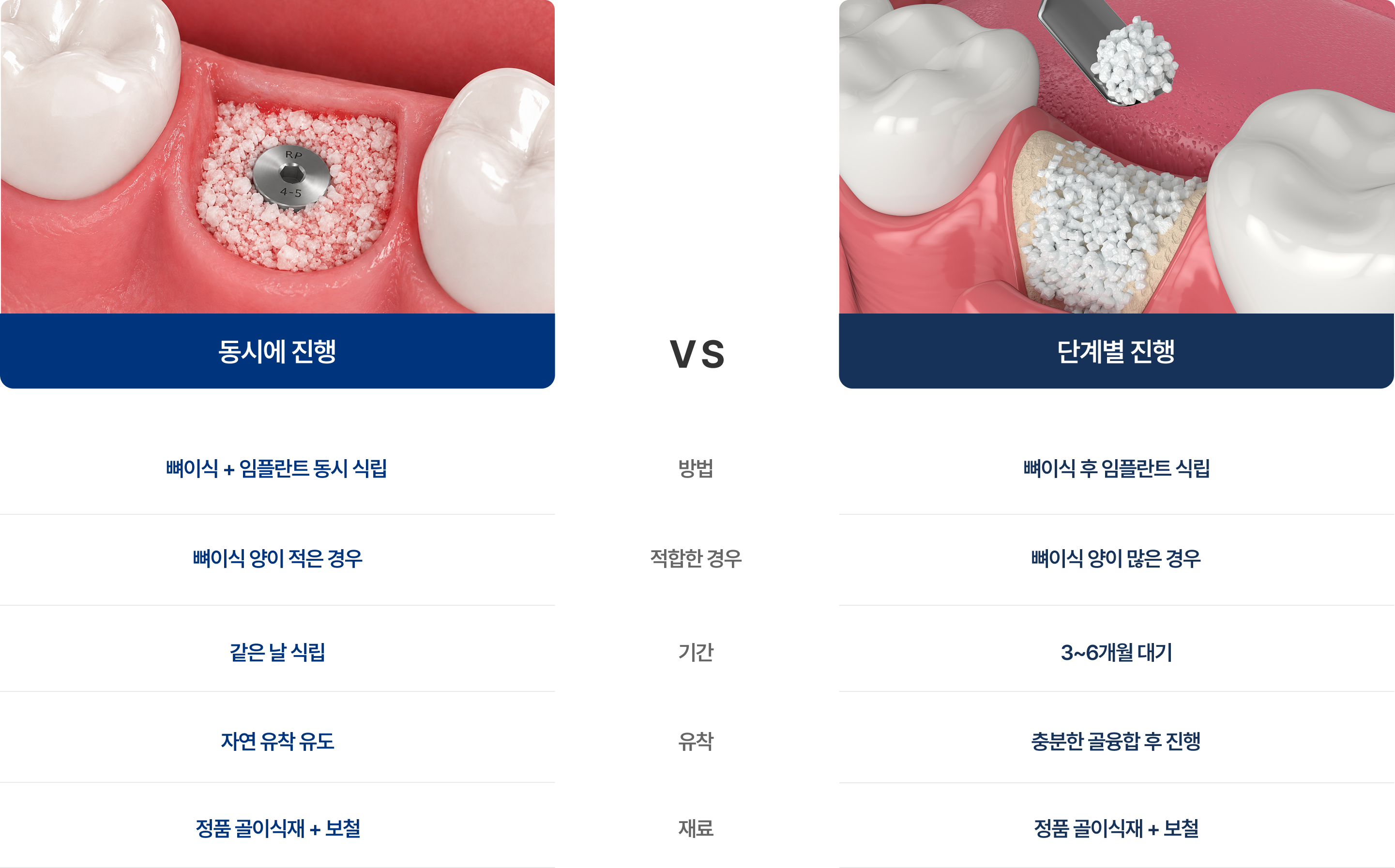 동시, 단계별 진행에 따른 뼈이식 임플란트의 차이점